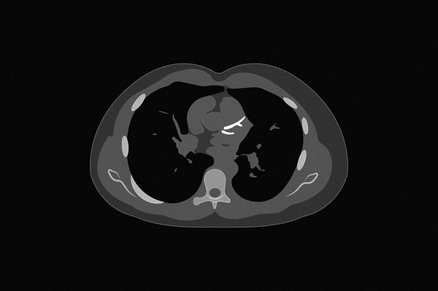 Axial coronary CT slice showing bright white calcified plaque in the heart's arteries