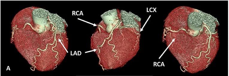 3D rendering of a heart with coronary arteries from a CT angiogram