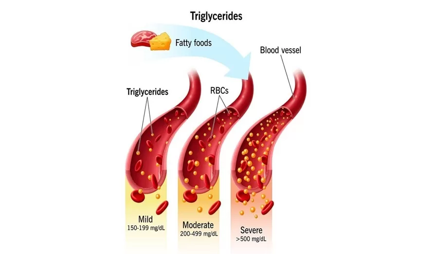 Illustration showing triglycerides building up in blood vessels at mild, moderate, and severe levels