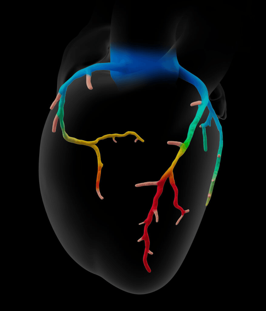 HeartFlow FFR-CT showing a 3D color-coded map of blood flow through the coronary arteries