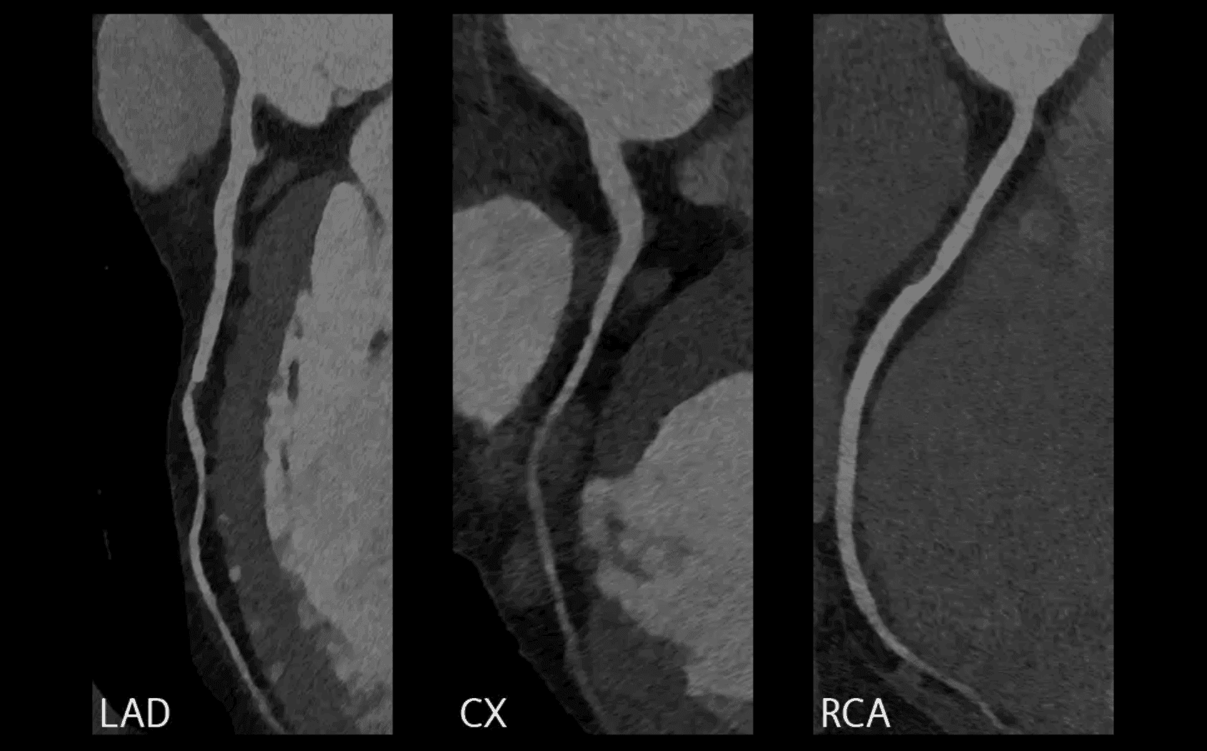 CCTA image showing the main coronary arteries