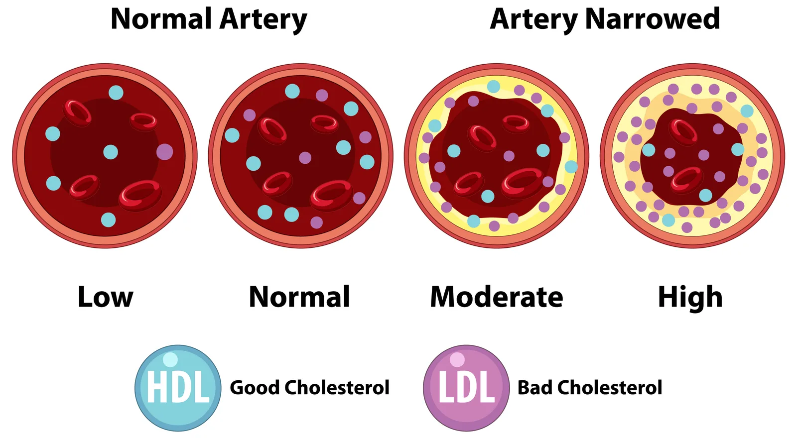 Illustration comparing open arteries with arteries narrowed by increasing plaque buildup