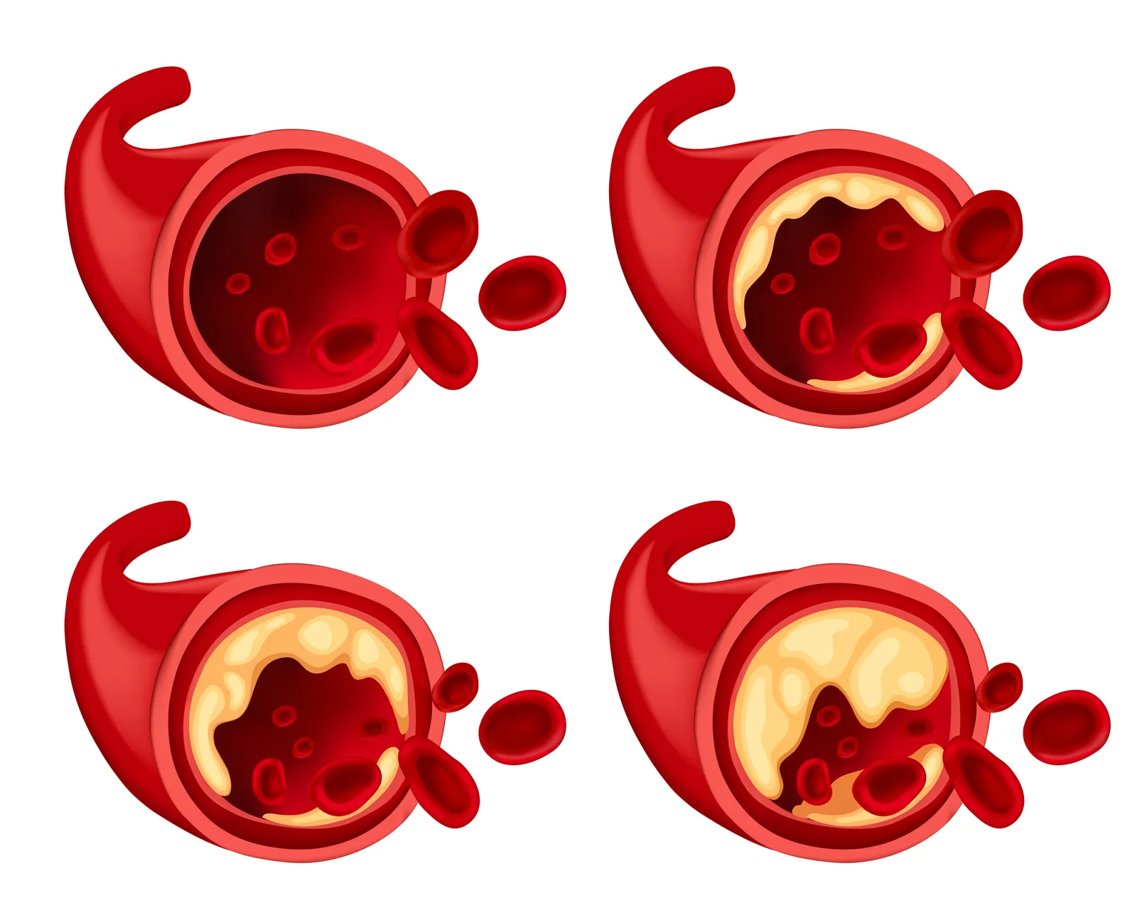 Four artery cross-sections showing progressively greater plaque buildup and narrowing