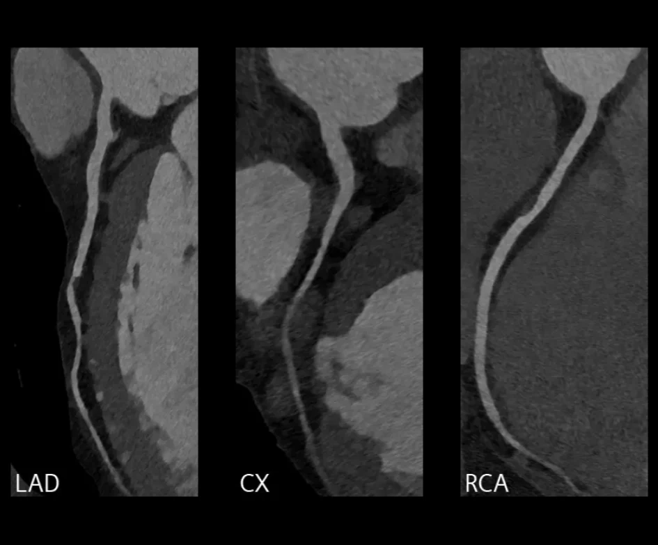 Coronary CT angiogram views of the LAD, circumflex, and right coronary arteries